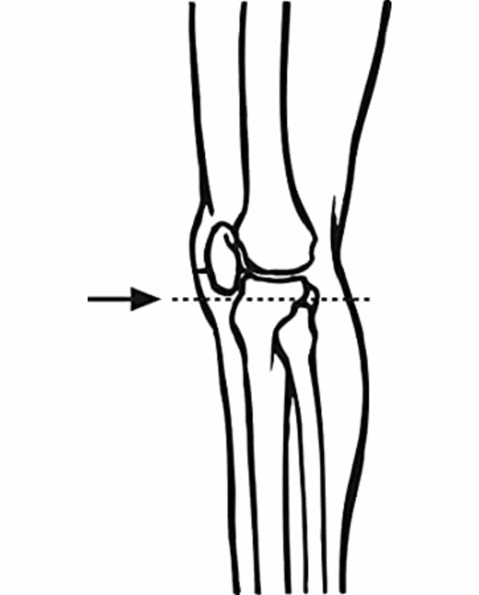 Bort Patella-Sehnenband Sport – Bild 3